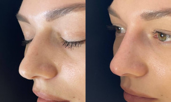 Філер Neauvia intensе для корекції носа